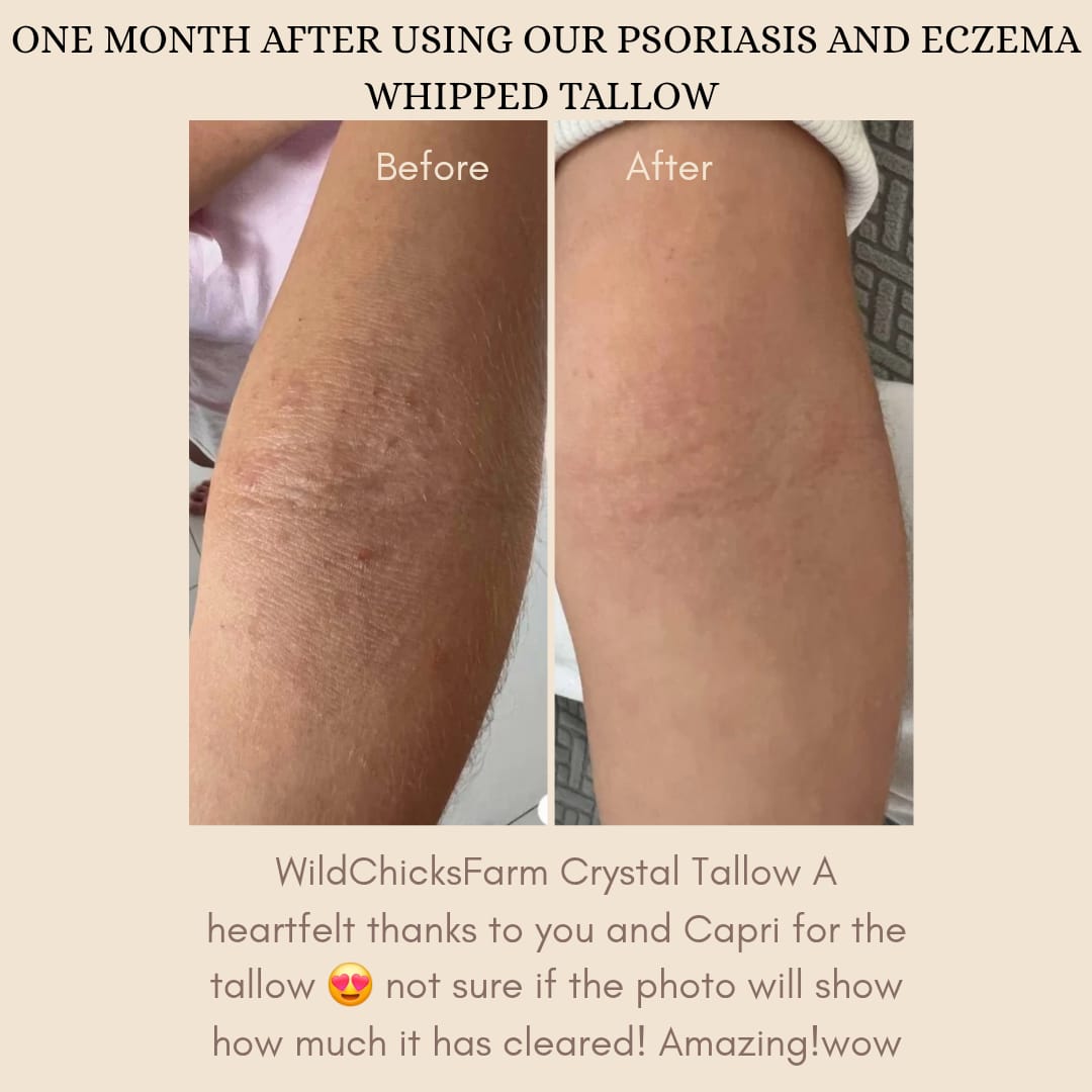 Psoriasis and Eczema Whipped Tallow